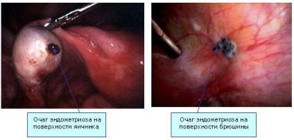 Menstruație dureroasă (dismenoree)