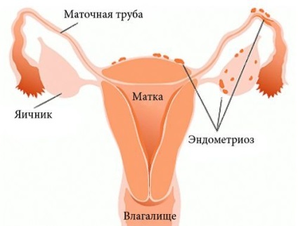 Menstruație dureroasă (dismenoree)