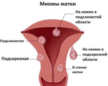 Fibromiomul uterului, simptomele și tratamentul cu medicamentele folclorice