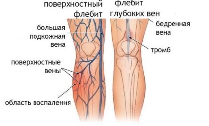 Flebita este o boală care necesită o atenție imediată unui medic