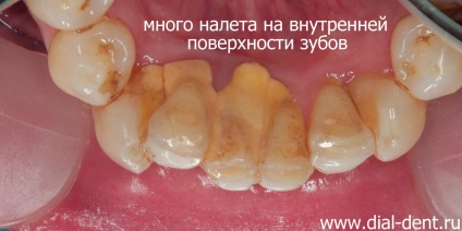 Curățarea igienică a dinților unui pacient care utilizează o periuță de dinți electrică