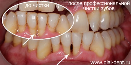 Curățarea igienică a dinților unui pacient care utilizează o periuță de dinți electrică