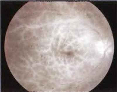 Sindromul ischemic ocular