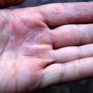 Ciuperca pe mâini cu infecții fungice