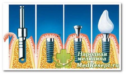 Procedurile de implantare dentară