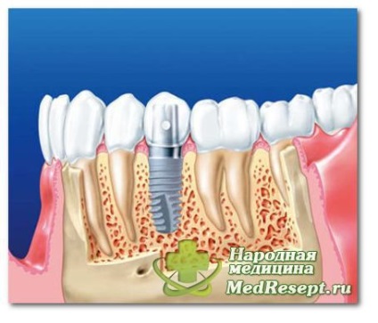 Procedurile de implantare dentară