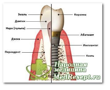 Procedurile de implantare dentară