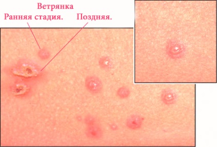 Perioada de incubație a varicelei la adulți și varicela
