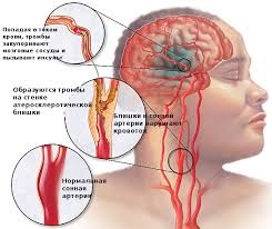 Accident vascular cerebral, neurocilina crapului