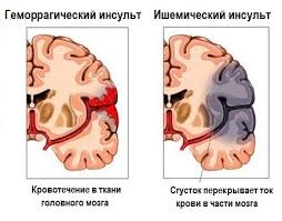 Accident vascular cerebral, neurocilina crapului