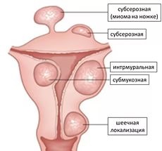 Mielul uterin intraligamentar