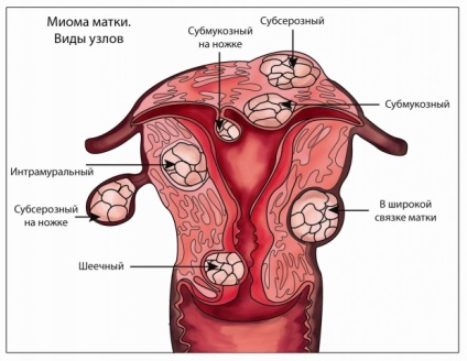 Mielul uterin intraligamentar