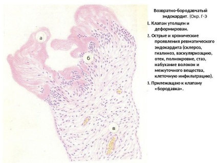 Infarctul ischemic al distrofiei hepatice hepatice grave