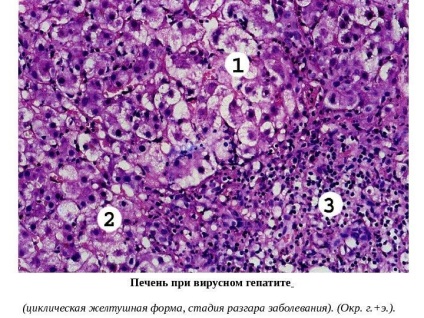 Infarctul ischemic al distrofiei hepatice hepatice grave