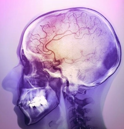 Ischemia creierului la adulți și copii simptome, semne și tratament