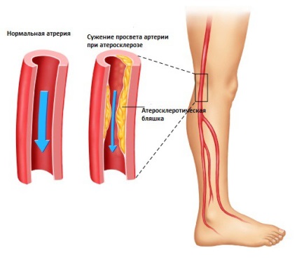 Ischemia extremelor inferioare - clasificare, simptome și tratament