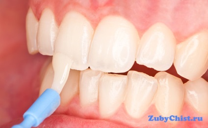 Cum de a restabili smalțul dintelui - ce instrumente vă vor ajuta