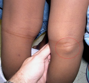 Chistul genunchiului cauzează simptome, dimensiuni, fotografie