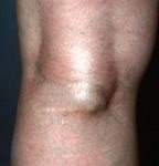 Chistul genunchiului cauzează simptome, dimensiuni, fotografie