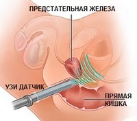 Chistul de prostată la bărbați simptome și tratament