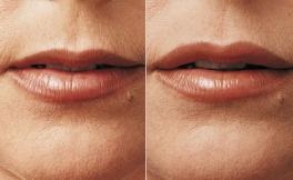 Clinica de frumusețe Dermatologia americană, corectarea formei și creșterea volumului buzelor