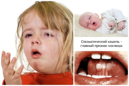 Pertussis - simptome, diagnostic și tratament video