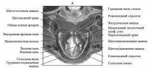 Anatomia computerizato-tomografică a laringelui în rasele de câini mezocefalici