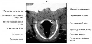 Anatomia computerizato-tomografică a laringelui în rasele de câini mezocefalici