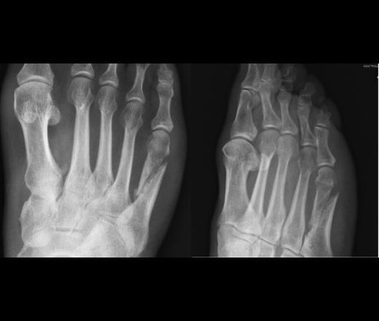 Consolidarea fracturilor, portalul radiologilor