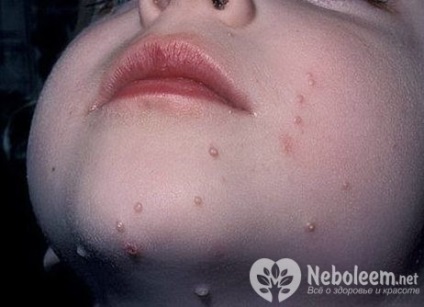 Molluscum contagiosum - simptome, tratament, prevenire