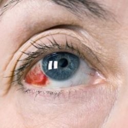 Vasele de sange rosii in ochii tratamentului - bisturiu - informatii medicale si portalul educational
