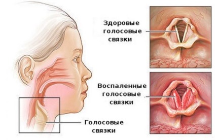 Laryngotracheitis felnőttek tünetei és kezelése