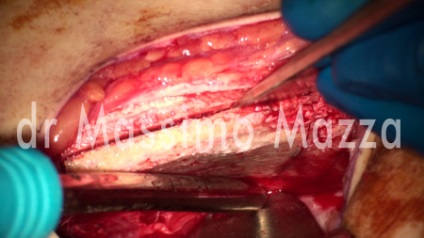 Funcționarea autotransplantului de pe creasta iliului cu reconstrucția 3D a maxilarului superior