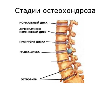 Osteocondroza coloanei vertebrale și toracice, simptome, tratament și prevenire