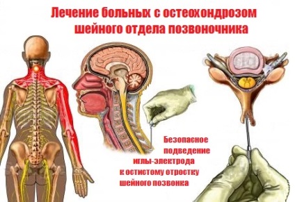 Остеохондроз шийного і грудного відділів хребта симптоми, лікування і профілактика