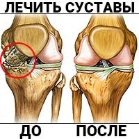 Osteocondroza coloanei vertebrale și toracice, simptome, tratament și prevenire