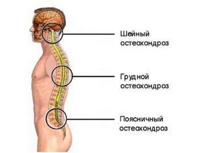 Osteocondroza coloanei vertebrale și toracice, simptome, tratament și prevenire