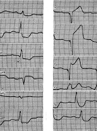 Akut miokardiális infarktus nagysága peredneseptalnoy vényköteles akár 3 napon belül - elektrokardiogram