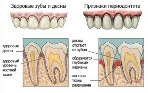 Periodontitis, szájüregi betegség - lehet a legjobb hely a fogászatban