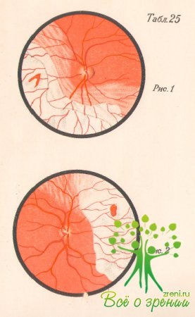 Afectarea retinei