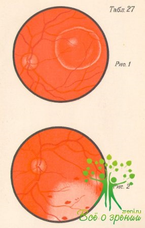 Afectarea retinei