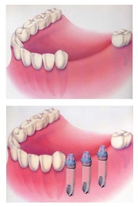 Protetica dinților și metodele de protetică dentară