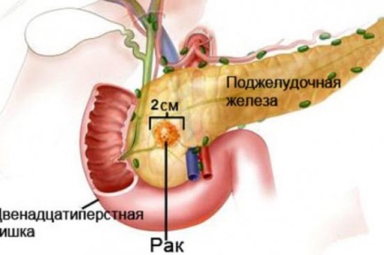 Cancer al capului stadiului pancreasului, simptome, prognostic