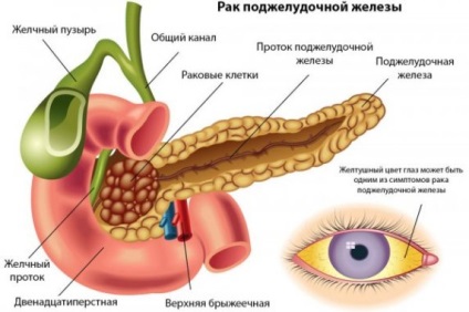 Cancer al capului stadiului pancreasului, simptome, prognostic