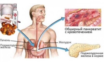 Cancer al capului stadiului pancreasului, simptome, prognostic
