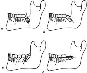 Retenția dinților - stomatologie, intervenții chirurgicale la nivelul osului alveolar - intervenții chirurgicale și tratament