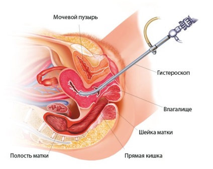 Șaua uterină este ceea ce înseamnă diagnosticul și tratamentul