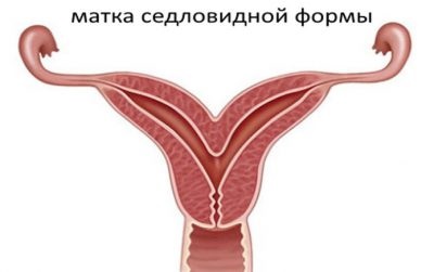 Șaua uterină este ceea ce înseamnă diagnosticul și tratamentul