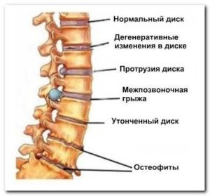 Simptomele osteocondrozei coloanei vertebrale și toracice