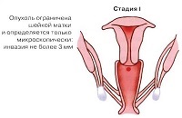 Câți trăiesc cu cancer de col uterin în 1 etapă, 2, 3 și 4 grade